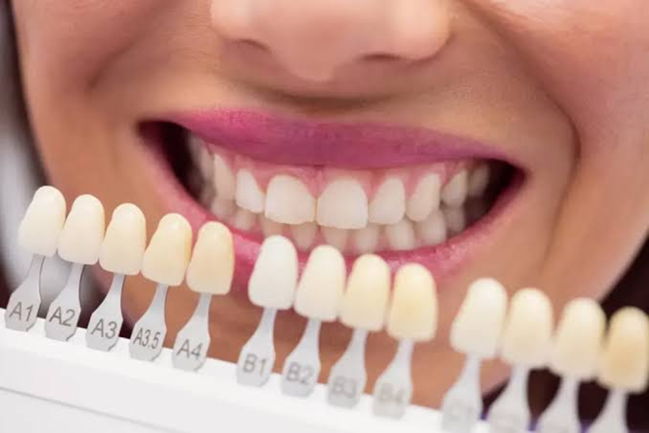 Porcelain Veneers vs Composite Veneers: What’s the Difference?